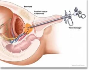 Laser Endo Urology Surgery